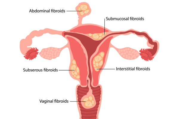 Uterine Abnormalities