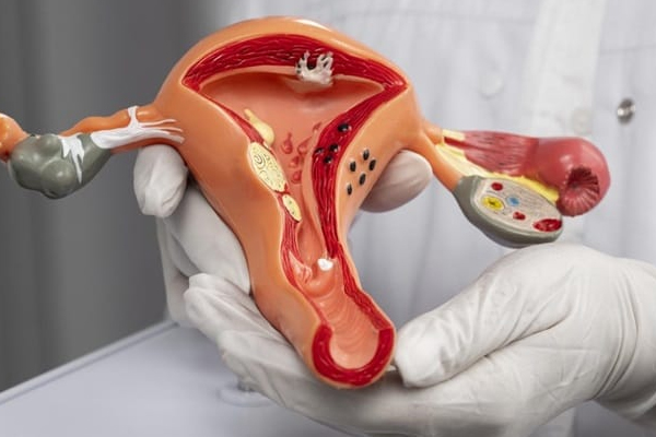 Blocked Fallopian Tubes