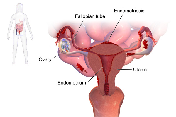  Endometriosis